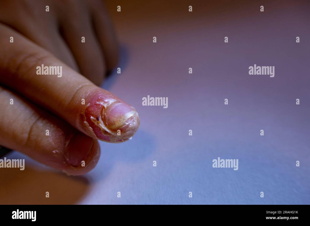 Finger geschwollen mit Entzündung durch Nagelriss-Infektion Stockfoto