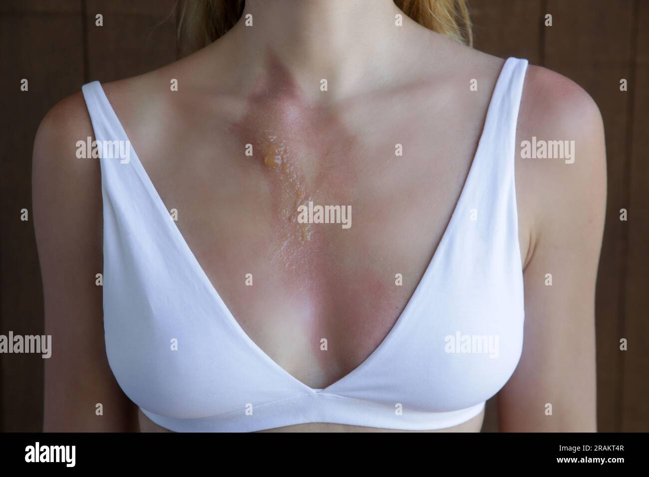 Brennen In Der Brust Frau Einseitig www.alamy.de
