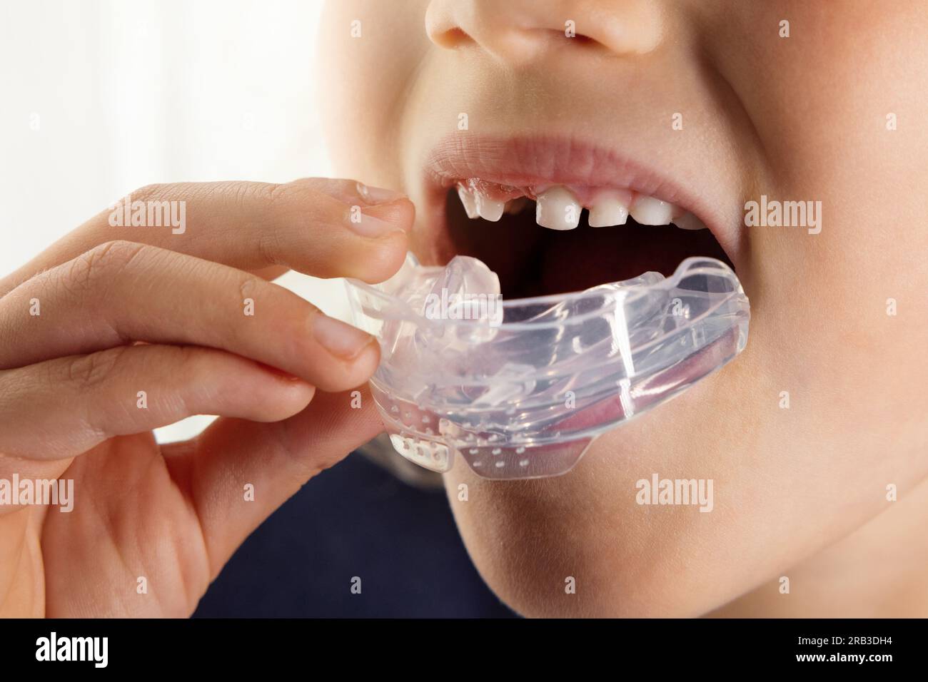 Ein Kind, das eine Silikonhalterung in den Mund einsetzt. Schlechte Mundhöhlenkorrektur, Kiefer richten sich aus und richten die Zähne aus Stockfoto
