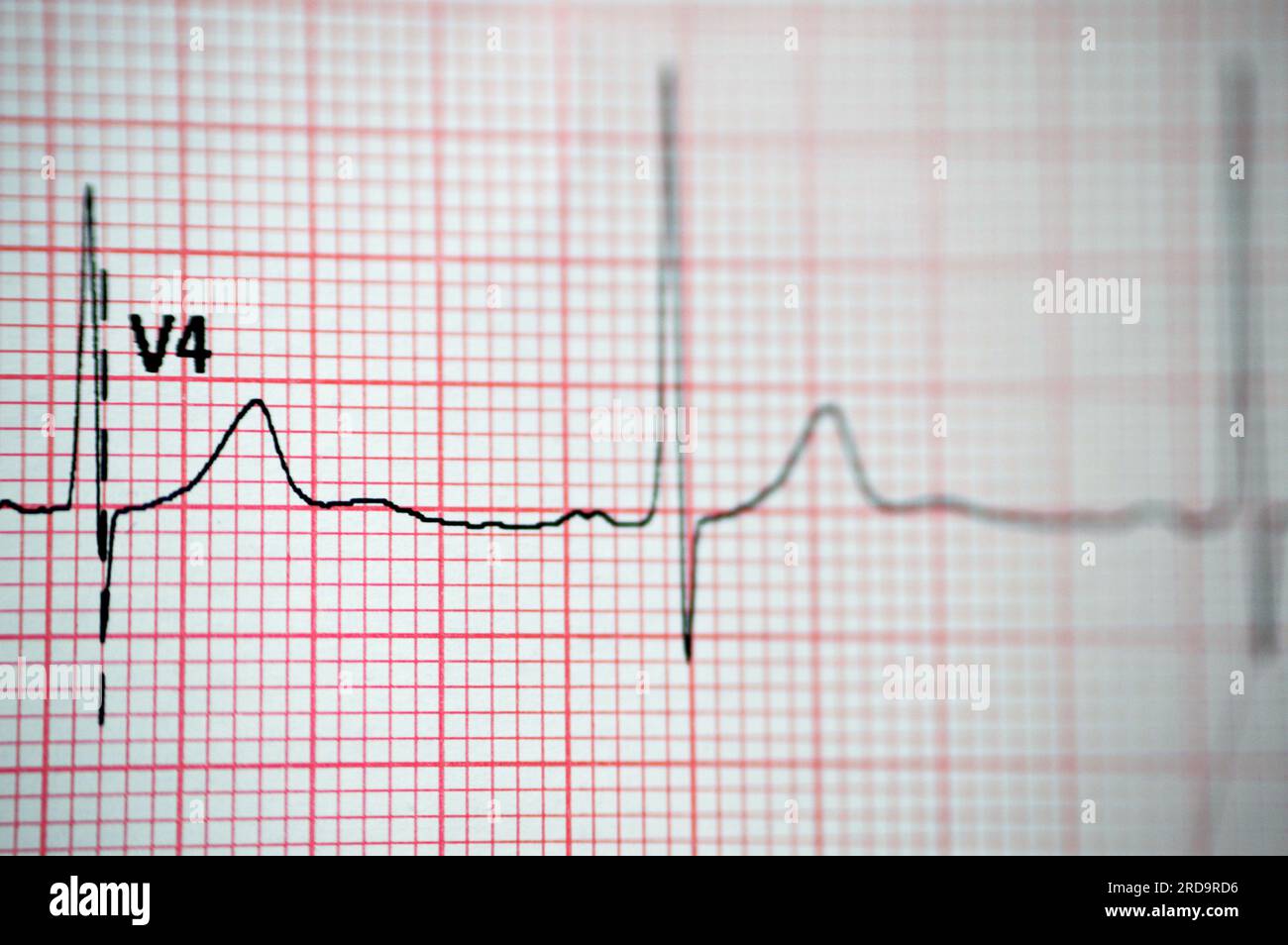 EKG-EKG-Papier, das eine Anomalie des Sinusrhythmus einer rechtsventrikulären Hypertrophie, einer inferioren T-Welle aufgrund von Hypertrophie und Ischämie zeigt, ab Stockfoto