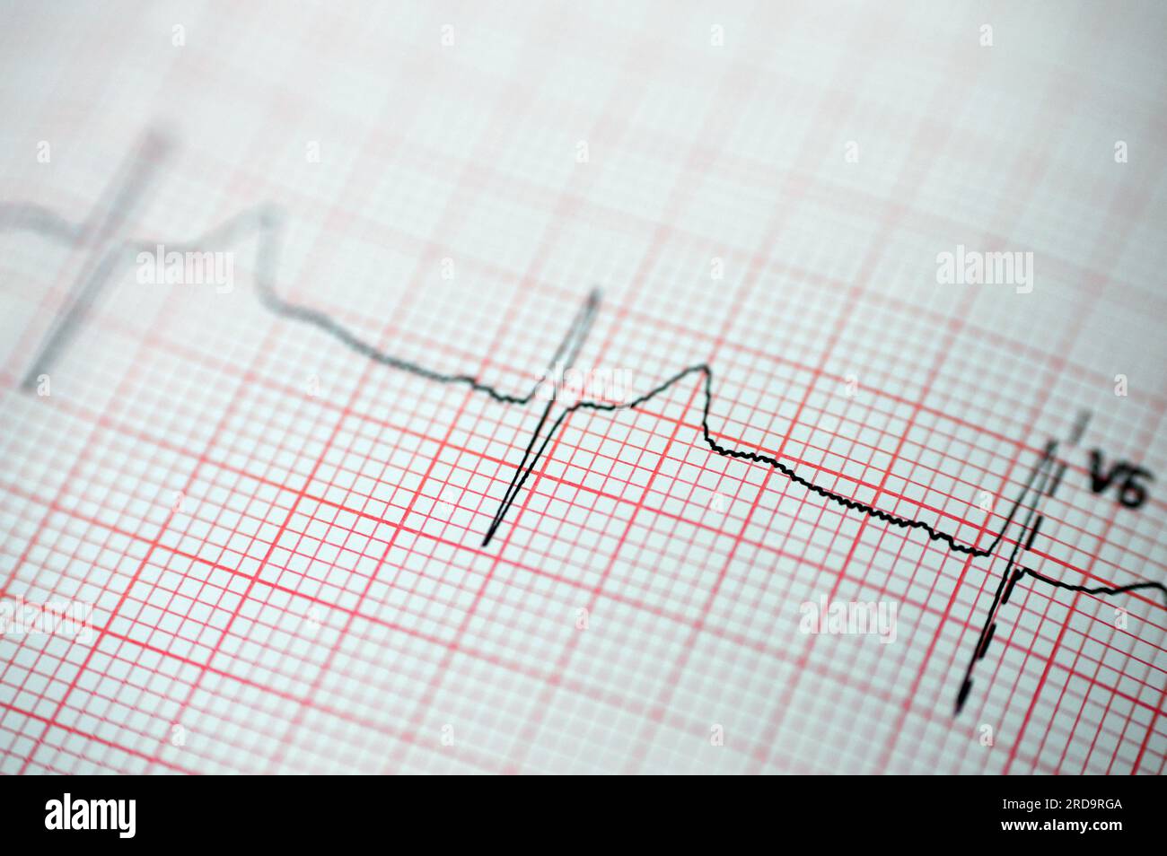 EKG-EKG-Papier, das eine Anomalie des Sinusrhythmus einer rechtsventrikulären Hypertrophie, einer inferioren T-Welle aufgrund von Hypertrophie und Ischämie zeigt, ab Stockfoto