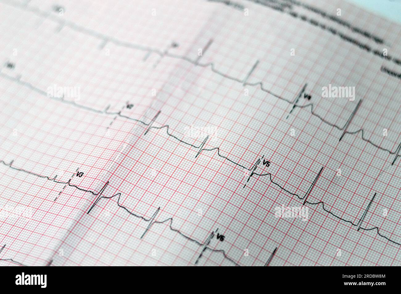 EKG-EKG-Papier, das eine Anomalie des Sinusrhythmus einer rechtsventrikulären Hypertrophie, einer inferioren T-Welle aufgrund von Hypertrophie und Ischämie zeigt, ab Stockfoto