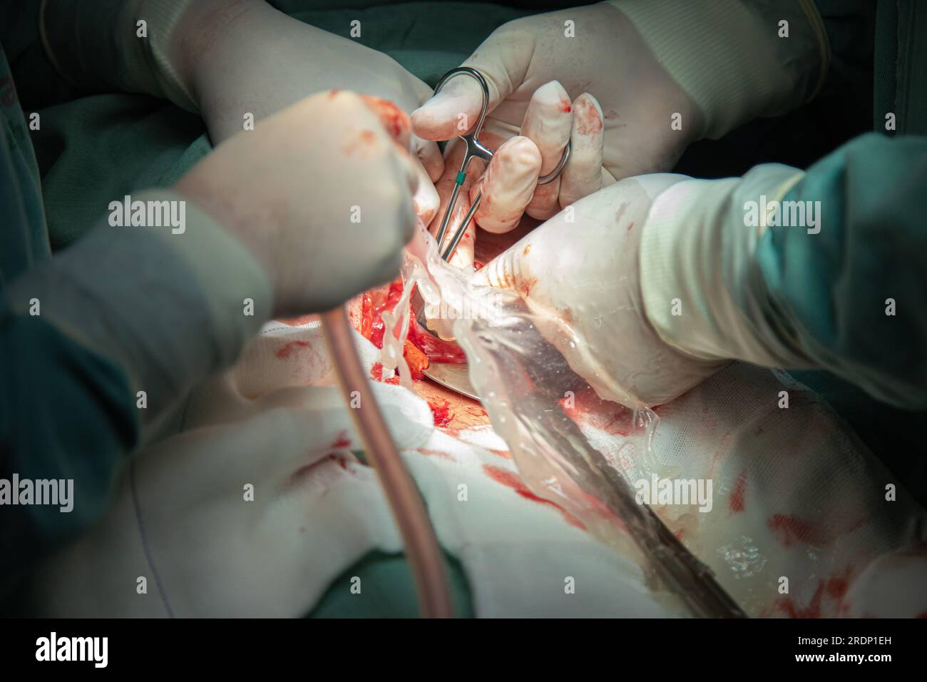 Kaiserschnitt-Entbindungsverfahren im Krankenhaus Stockfoto