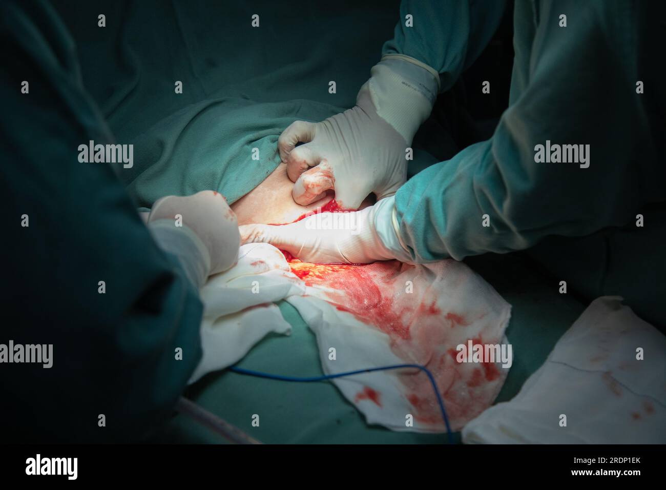 Kaiserschnitt-Entbindungsverfahren im Krankenhaus Stockfoto