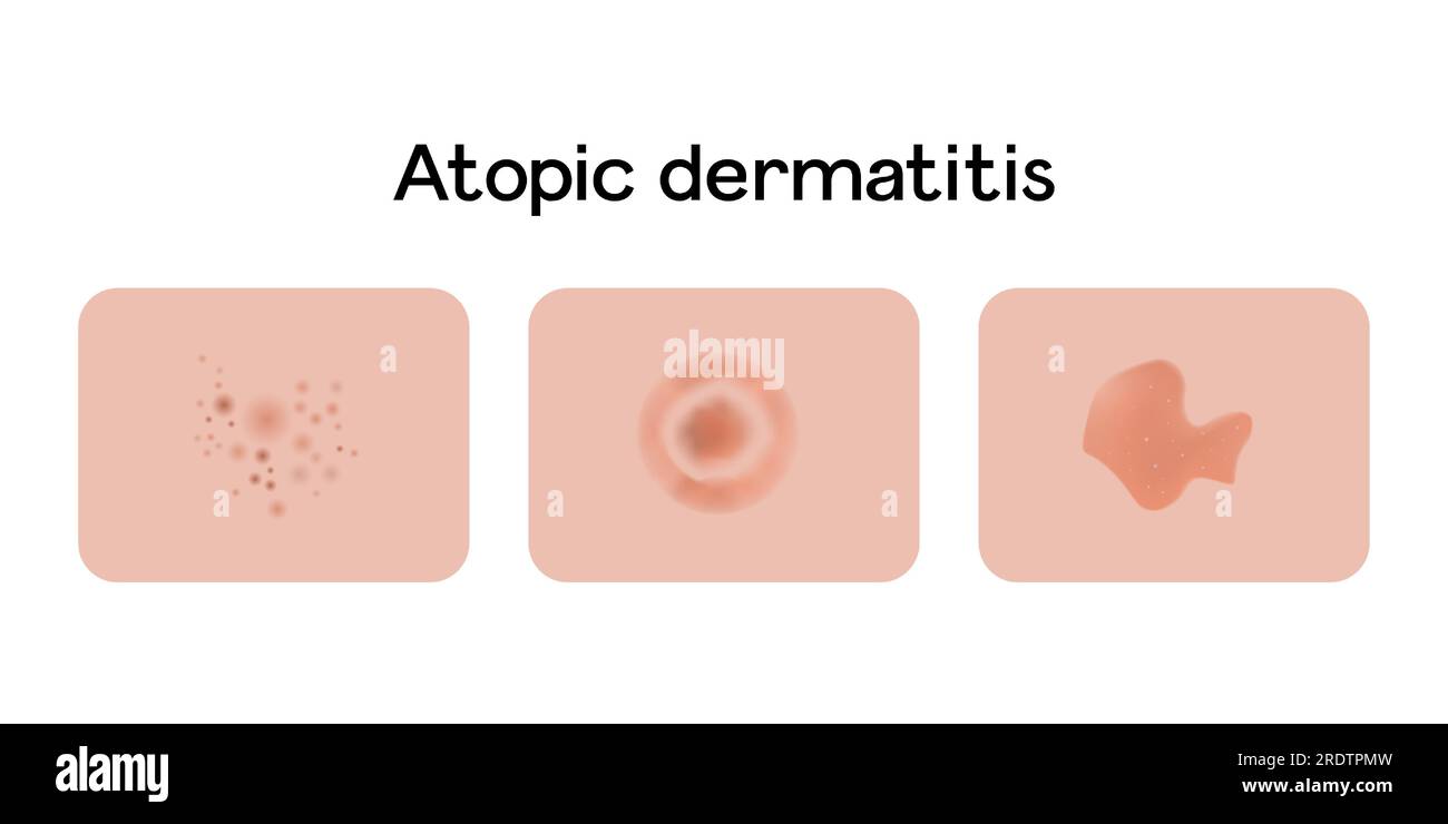 Atopische Dermatitis Beispiele Vektordarstellung Design, medizinische Probleme Stock Vektor