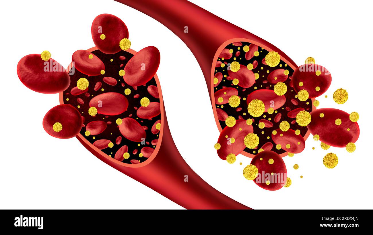 Diabetes und Diabetiker und Blutzucker als Symbol für Hypoglykämie und Hyperglykämie oder normale Glukosespiegel als Symbol für niedrigen hohen Blutzucker Stockfoto