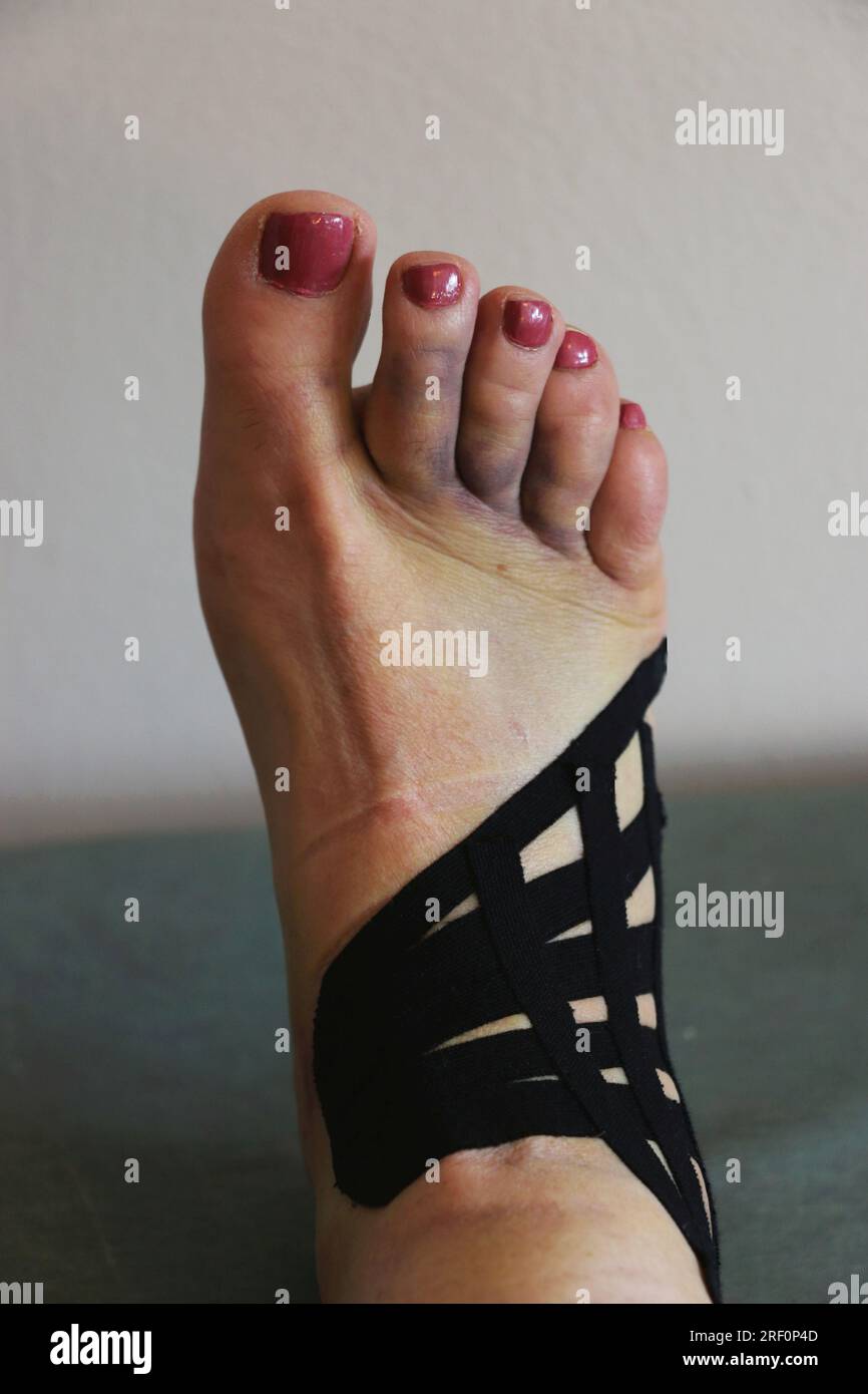Frauenfuß mit Kreuzschlitz-Verband für verstauchten Knöchel. Fuß und Zehen zeigen Ekchymosen und Blutergüsse. Stockfoto