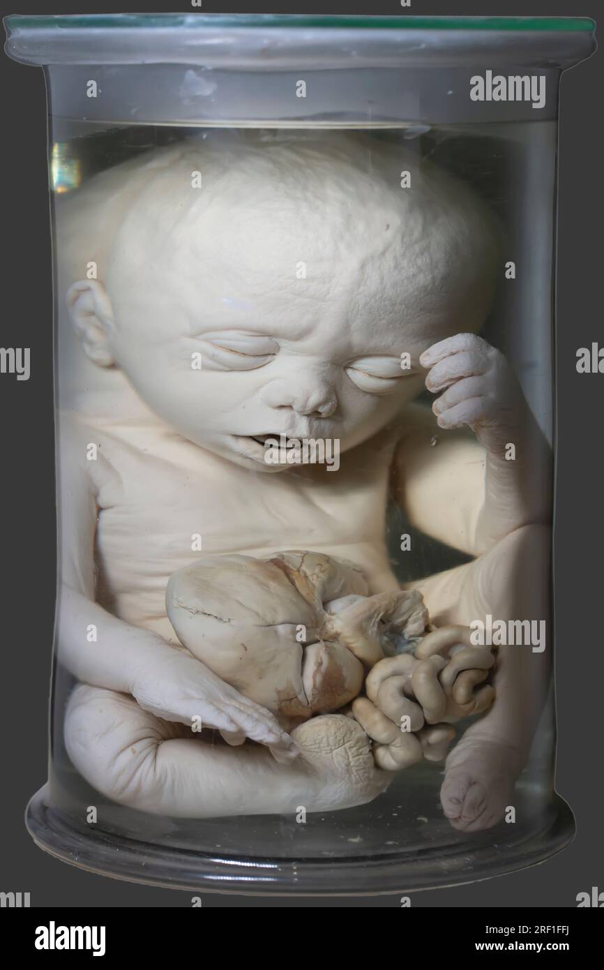 1. April 2023 Ausstellung anatomischer Ausstellungen. Menschlicher Säugling mit pathologischer Entwicklung der Mikrozephalie. Menschlicher Zwerg. Achondroplasie. Stockfoto
