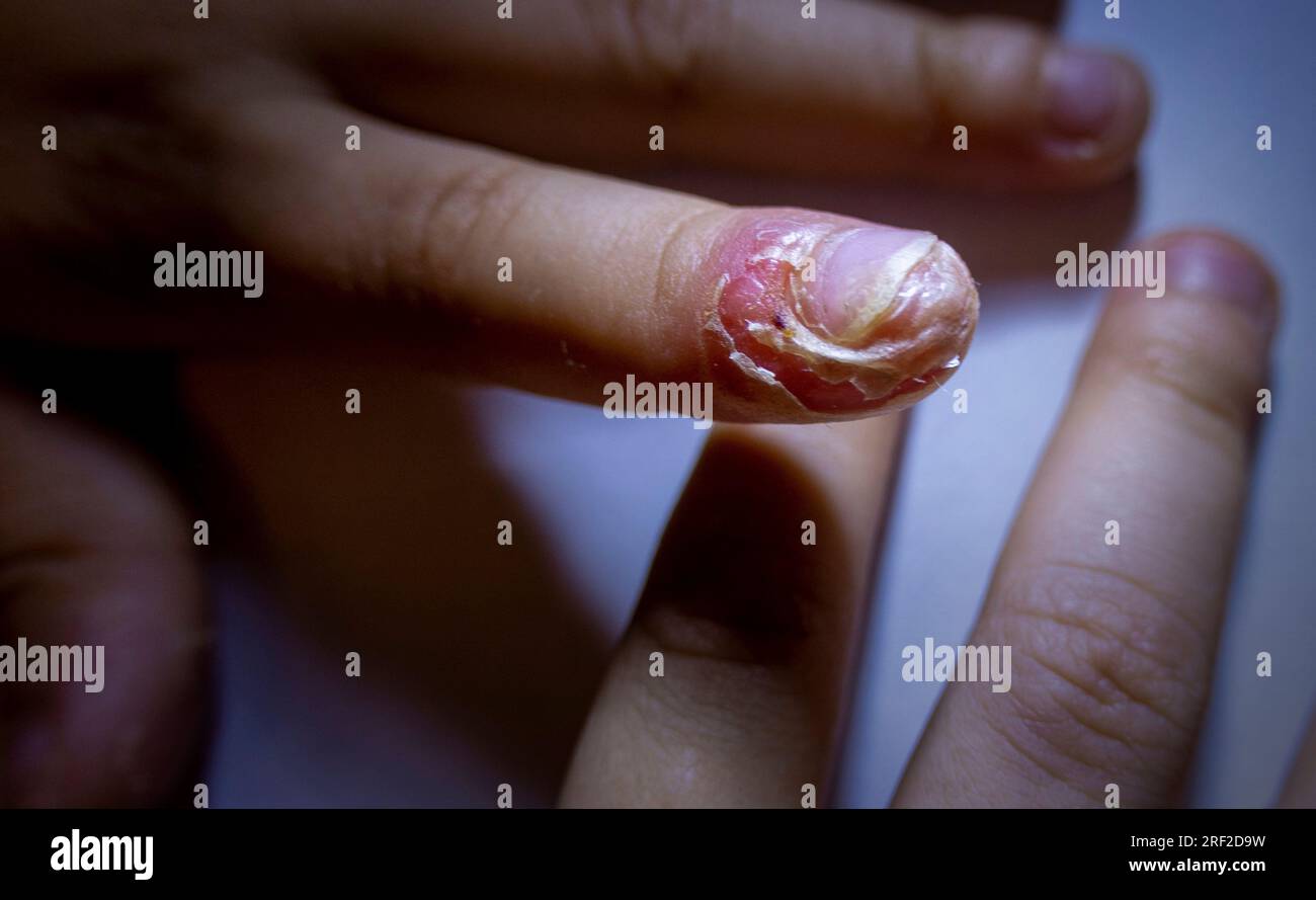 Finger geschwollen mit Entzündung durch Nagelriss-Infektion Stockfoto