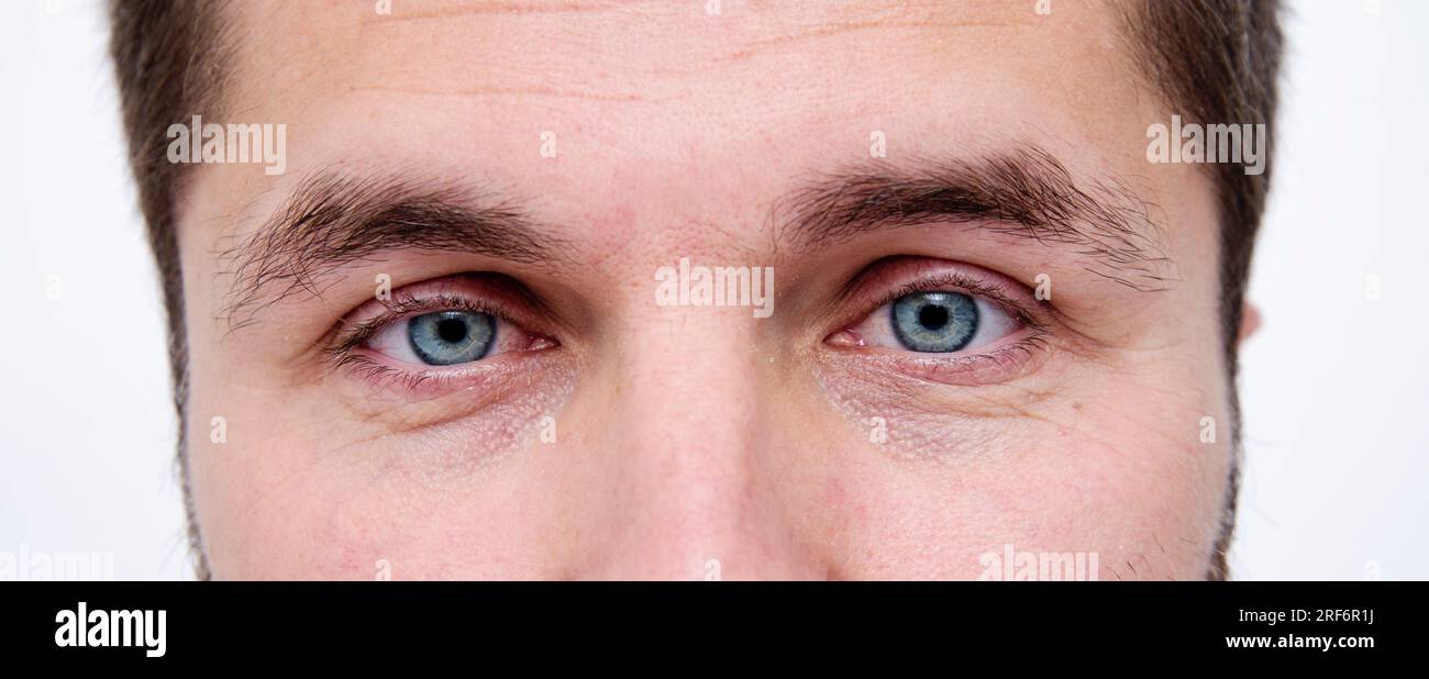Nahaufnahme der leuchtend blauen Augen eines Mannes. Auge eines jungen Mannes mit Katarakt, Linsentrübung, Makro. Stockfoto