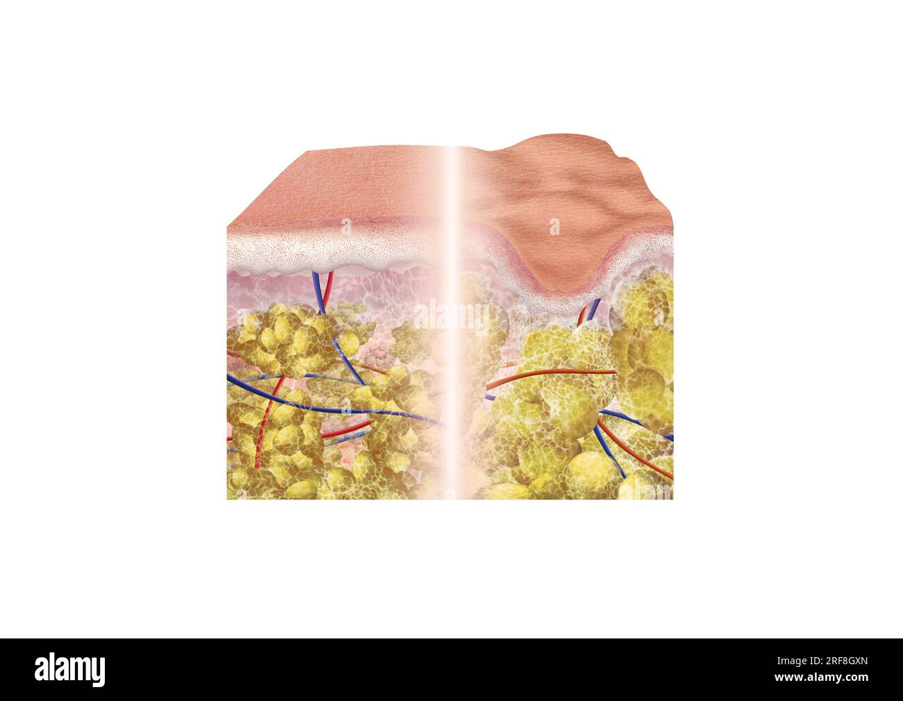 Ein Abschnitt glatter Haut, der mit Cellulite, Epidermis, Dermis und Hypodermis, Kollagenfasern an einen Abschnitt der Haut geklebt ist. Stockfoto