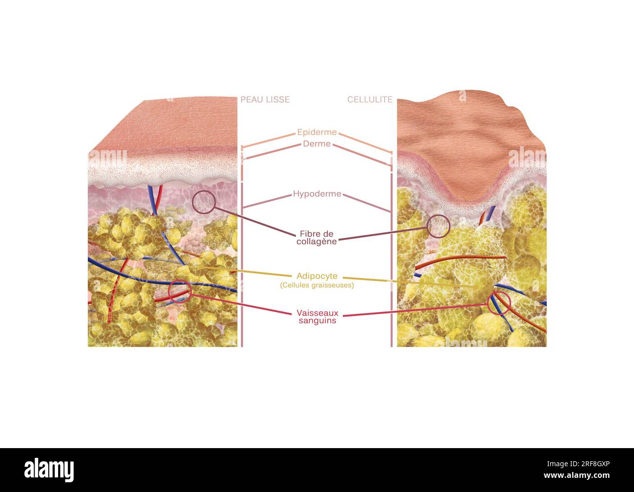 Hautabschnitt mit Cellulite im Vergleich zu einem Abschnitt glatter Haut mit Farbenlegende, Epidermis, Dermis und Hypodermis, Kollagenfasern. Stockfoto