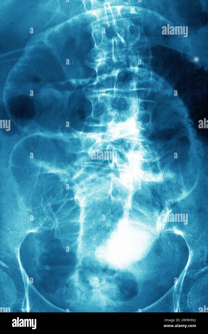 Chronische Kolitis (entzündliche Darmerkrankung), aufgedeckt durch eine frontale Abdominalröntgenuntersuchung. Stockfoto