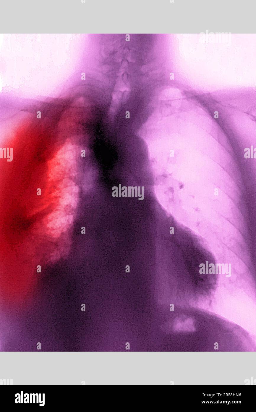 Lungenkrebs (rechts), dargestellt durch eine AP-Thoraxröntgenuntersuchung. Stockfoto