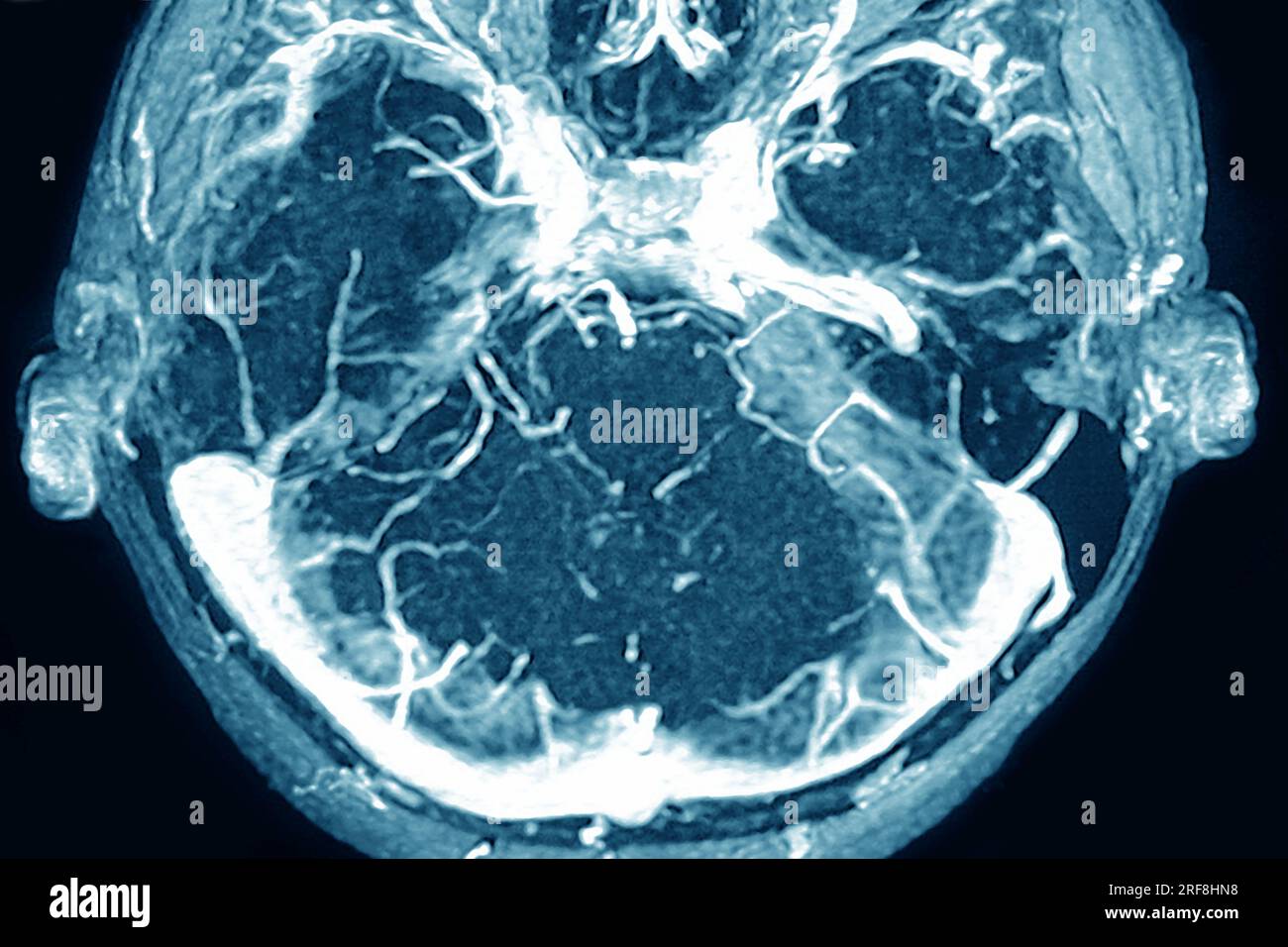 Thrombose der Hirnvenenhöhlen der Dura mater, dargestellt durch kraniale MRT-Angiographie. Stockfoto
