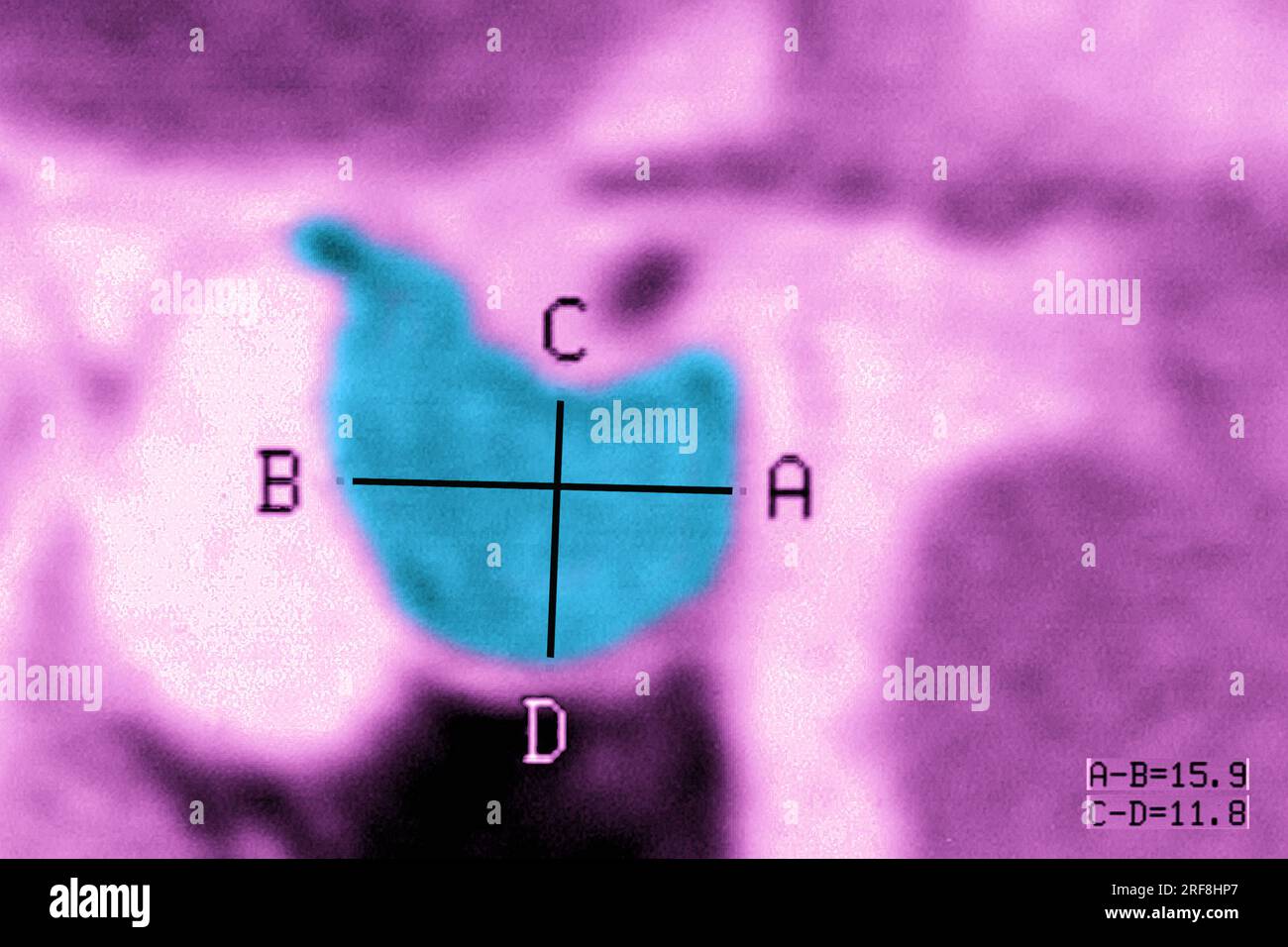 Hypophysenadenom im MRT des Schädels im sagittalen Schnitt. Stockfoto