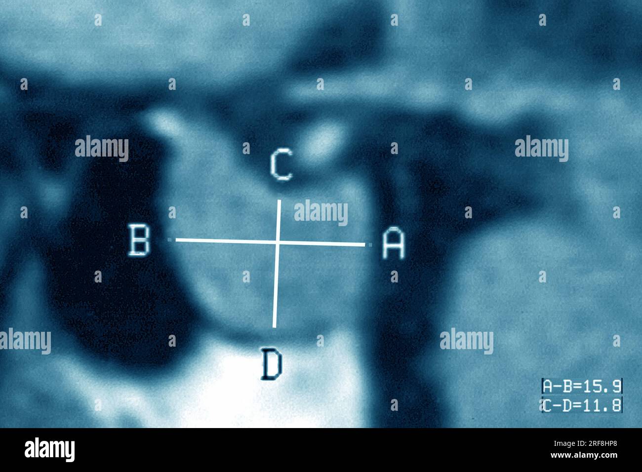 Hypophysenadenom im MRT des Schädels im sagittalen Schnitt. Stockfoto
