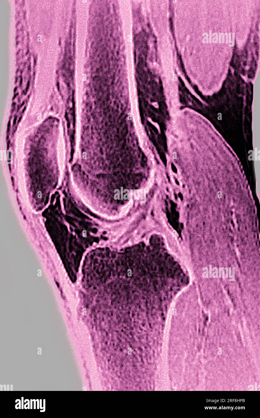 MRT-Darstellung des normalen Kniegelenks bei sagittaler Schnittentbindung. Stockfoto