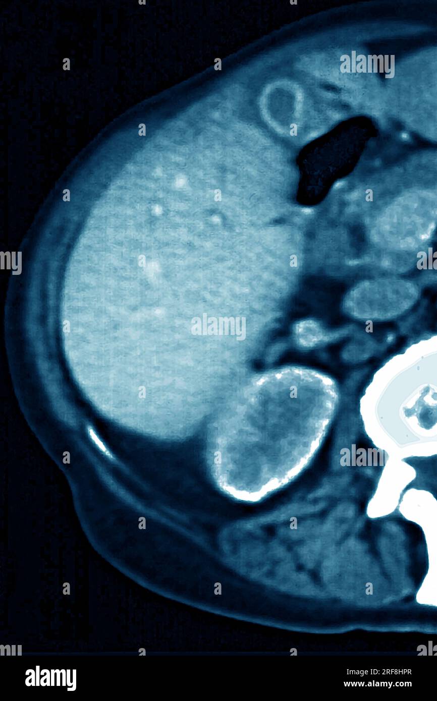 Lymphom, aufgedeckt durch Lymphadenopathie zwischen Leber und Gallenblase. Abdomen-Scan im Radialschnitt. Stockfoto