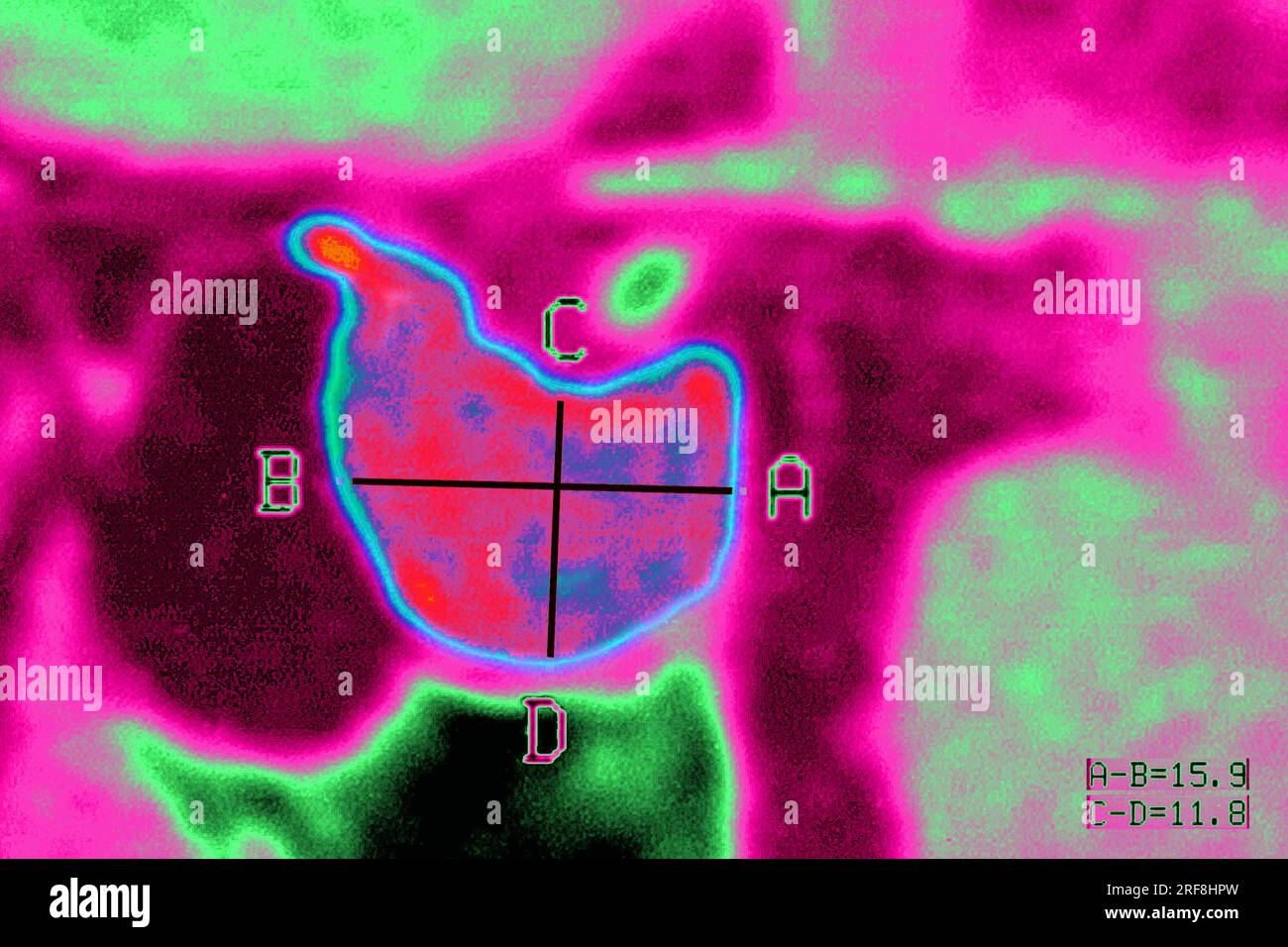 Hypophysenadenom im MRT des Schädels im sagittalen Schnitt. Stockfoto