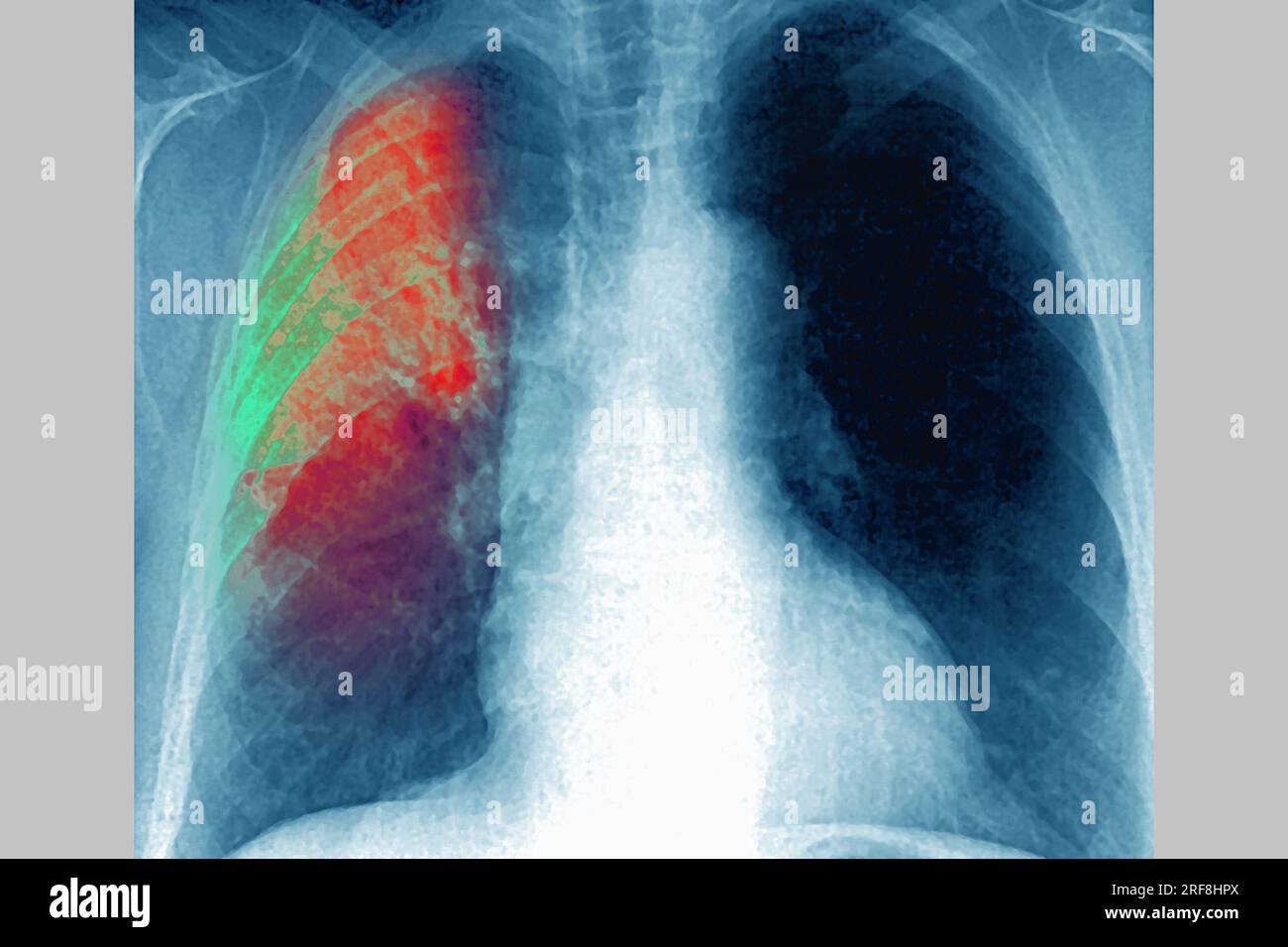 Pneumonie in der rechten Lunge (akute Atemwegsinfektion), aufgedeckt durch frontales Thoraxröntgenbild. Stockfoto