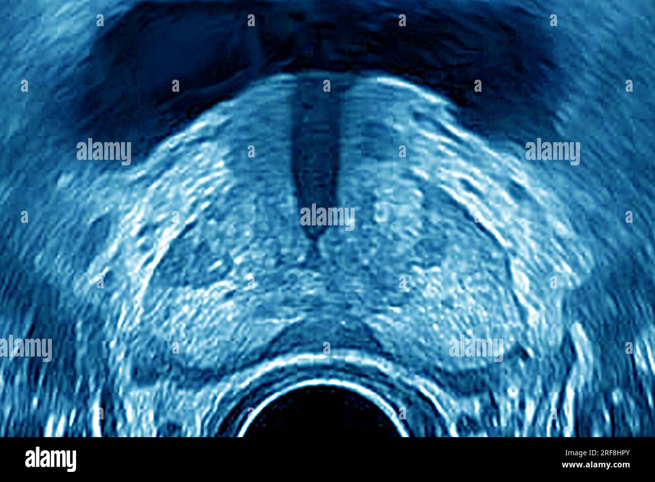 Prostata (gesunde Prostata), sonographisch in frontaler Sicht dargestellt. Stockfoto