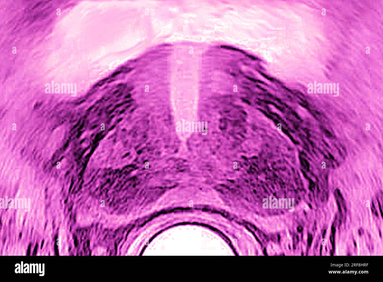 Prostata (gesunde Prostata), sonographisch in frontaler Sicht dargestellt. Stockfoto