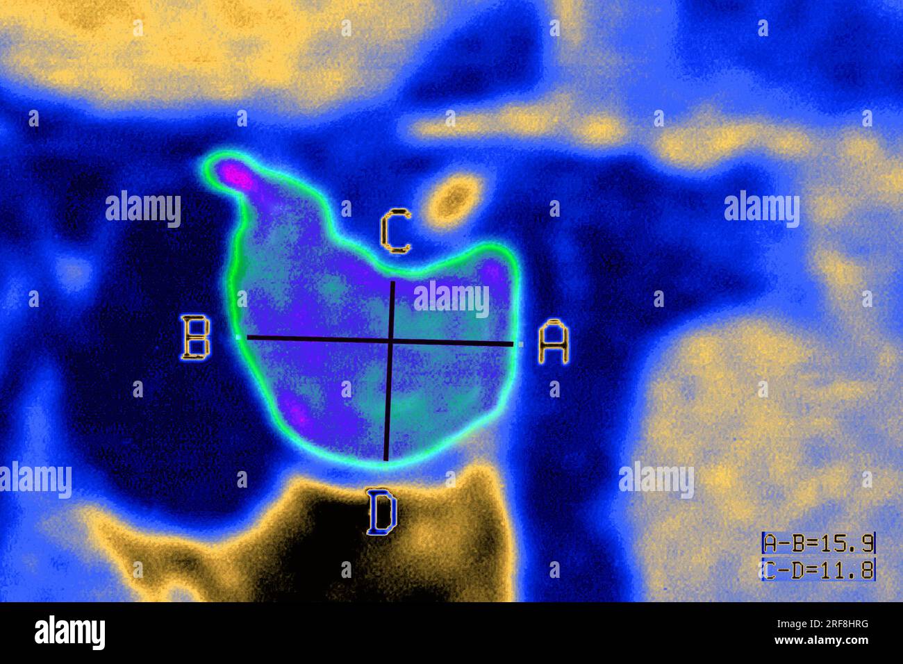 Hypophysenadenom im MRT des Schädels im sagittalen Schnitt. Stockfoto