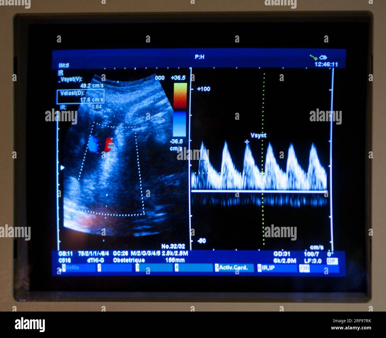 Ultraschall im 8. Schwangerschaftsmonat auf der Entbindungsstation eines Krankenhauses. Stockfoto