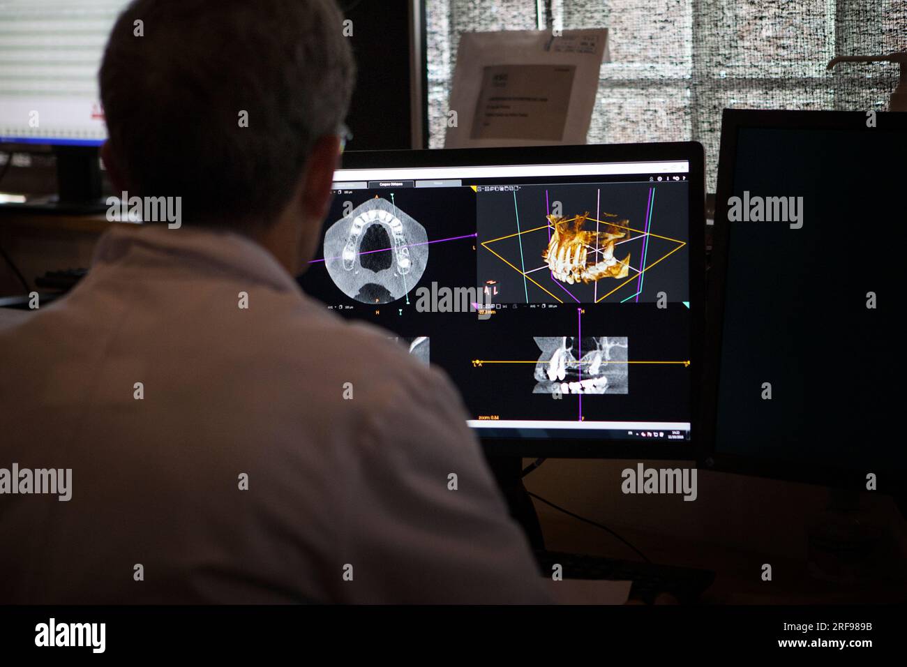 Ein Radiologe beobachtet einen CT-Scan des zur Implantatplatzierung geplanten Kiefers. Stockfoto
