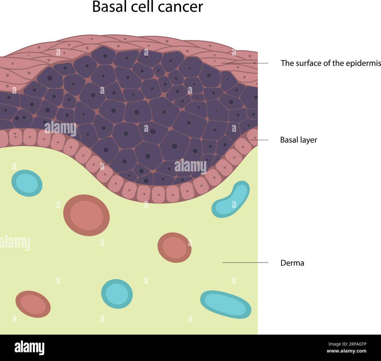 Basalzellkarzinom. Hautkrankheit. Tumorzellen. Stock Vektor