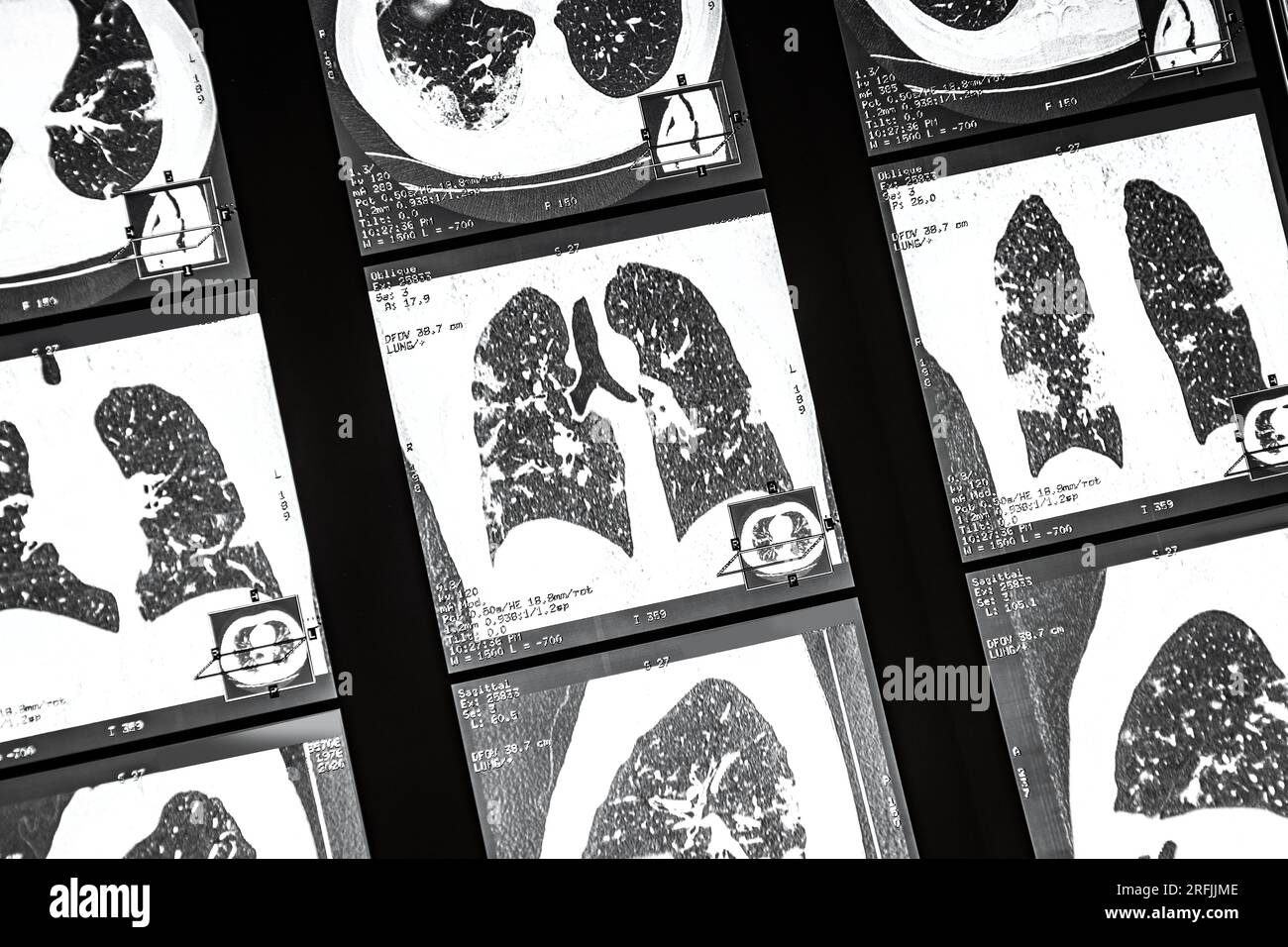 Film-CT-Computertomographie der Lunge - Covidschadenanalyse Stockfoto