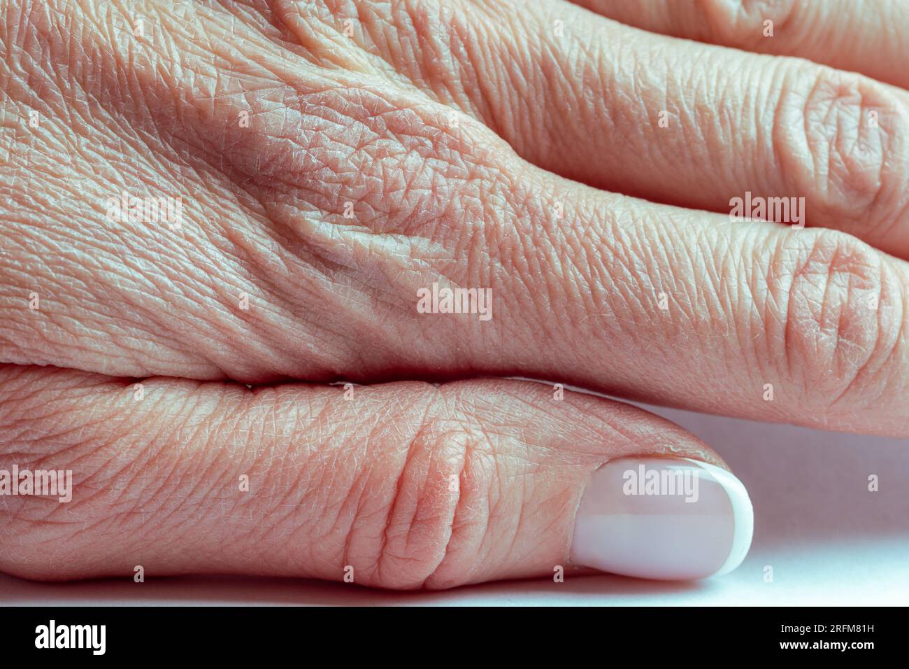 Nahaufnahme der zerknitterten Haut an der Hand einer älteren Frau mit einigen Läsionen aktinischer Keratose oder Sonnenflecken. Die Konsistenz der menschlichen Haut. Stockfoto