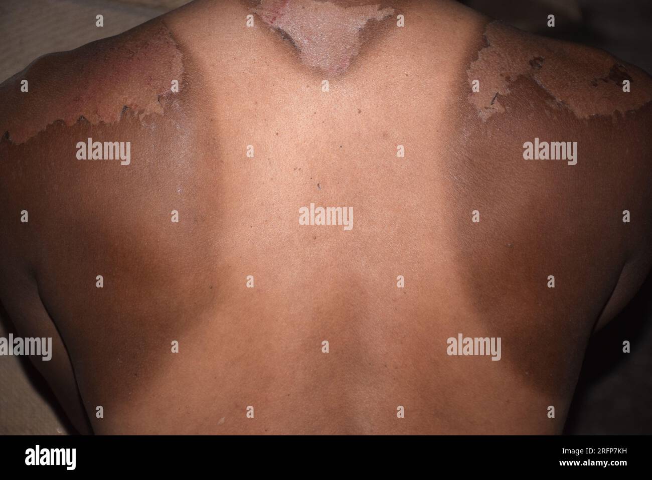 Sonnenbrand auf dem Rücken eines Mannes. Kräftige Bräune im Mann. Rote Hände und Rücken. Wunde Haut, Blasen. Kein Sonnenschutz Stockfoto