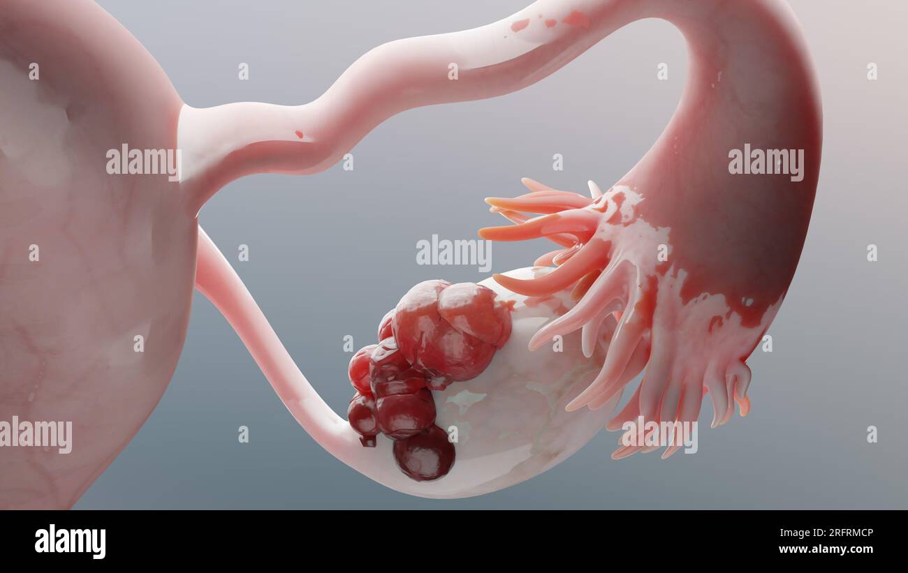Muss Ein Ovarialtumor Operiert Werden
