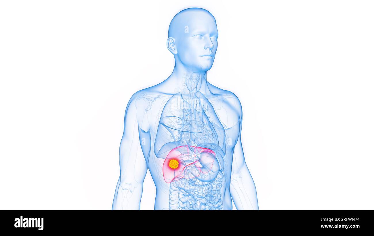 Spcl Rfwn Neoplastischer tumor -Fotos und -Bildmaterial in hoher Auflösung – Alamy