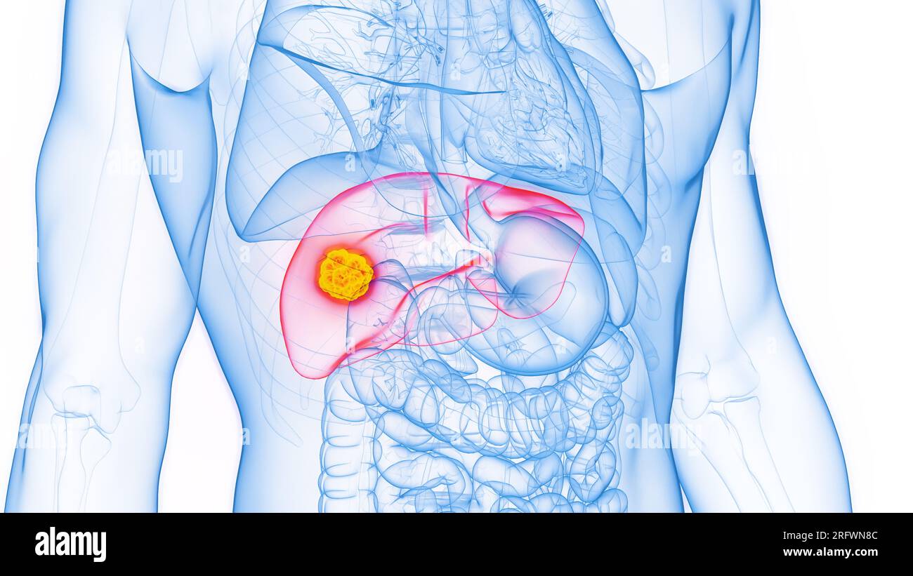 Spcl Rfwn Neoplastischer tumor -Fotos und -Bildmaterial in hoher Auflösung – Alamy