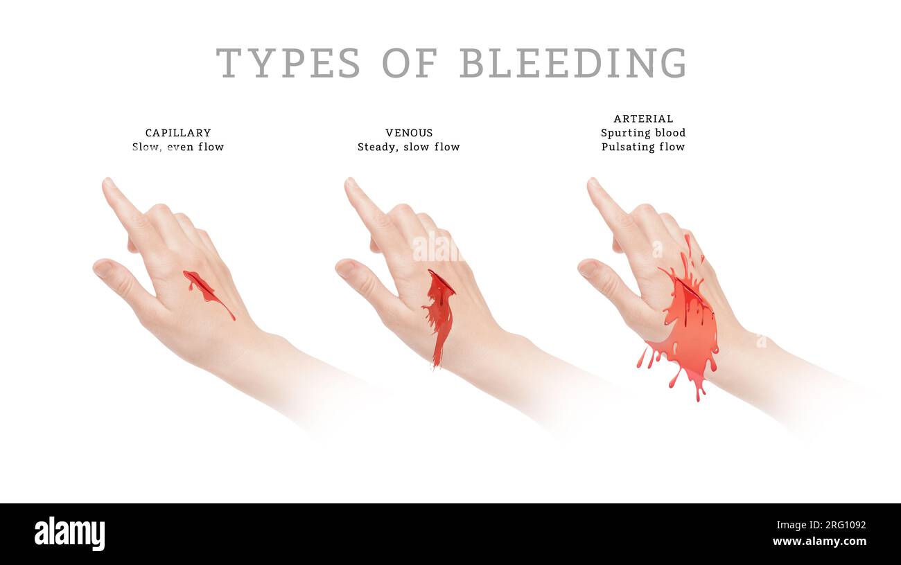 Drei Hauptarten von Blutungen Stockfoto