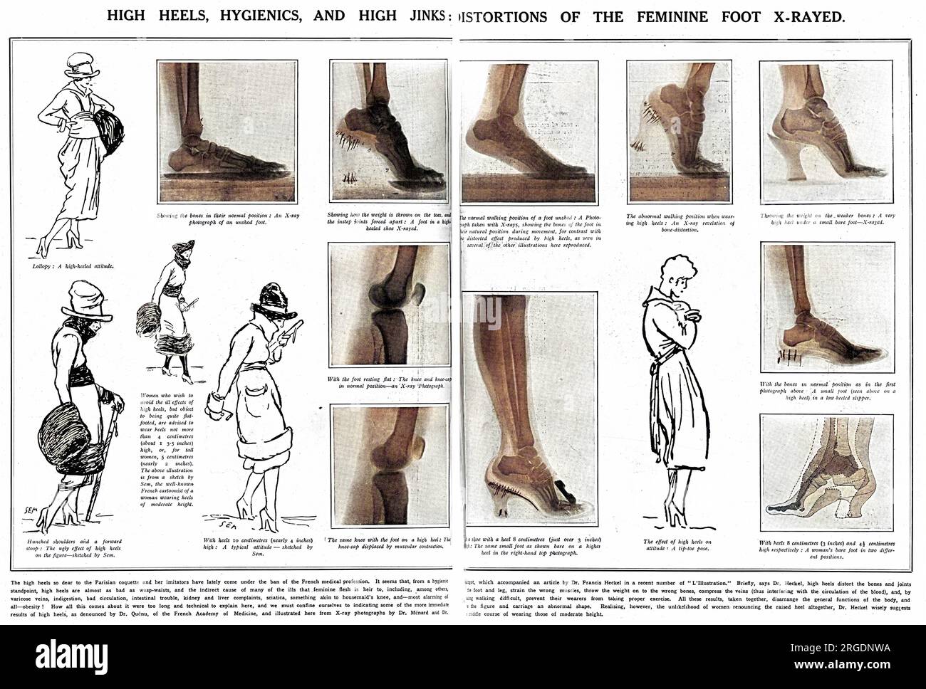 Eine Doppelseite aus dem Sketch berichtet über die unnatürlichen Belastungen, die auf die Füße durch das Tragen von hohen Absätzen, die von der französischen Ärzteschaft verboten, schlecht für die Füße und ermutigende schlechte Haltung. Frauen, die sich gegen flache Füße aussprachen, wurde empfohlen, Absätze von nicht mehr als vier Zentimetern zu tragen. Die Skizzen unter den Röntgenaufnahmen stammen von dem berühmten französischen Karikaturisten Sem. Stockfoto