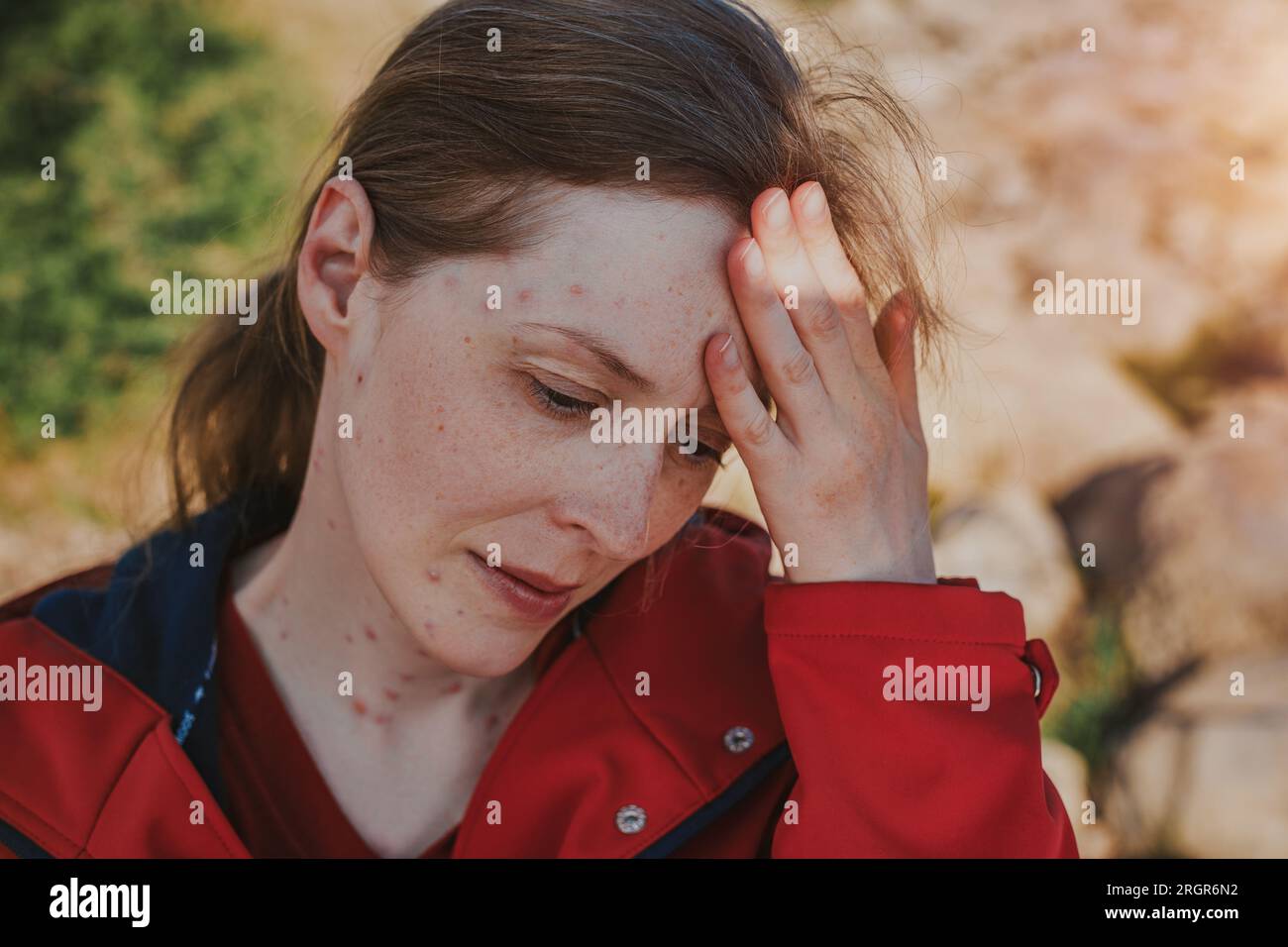 Porträt einer traurigen Frau mit Windpocken im Freien Stockfoto