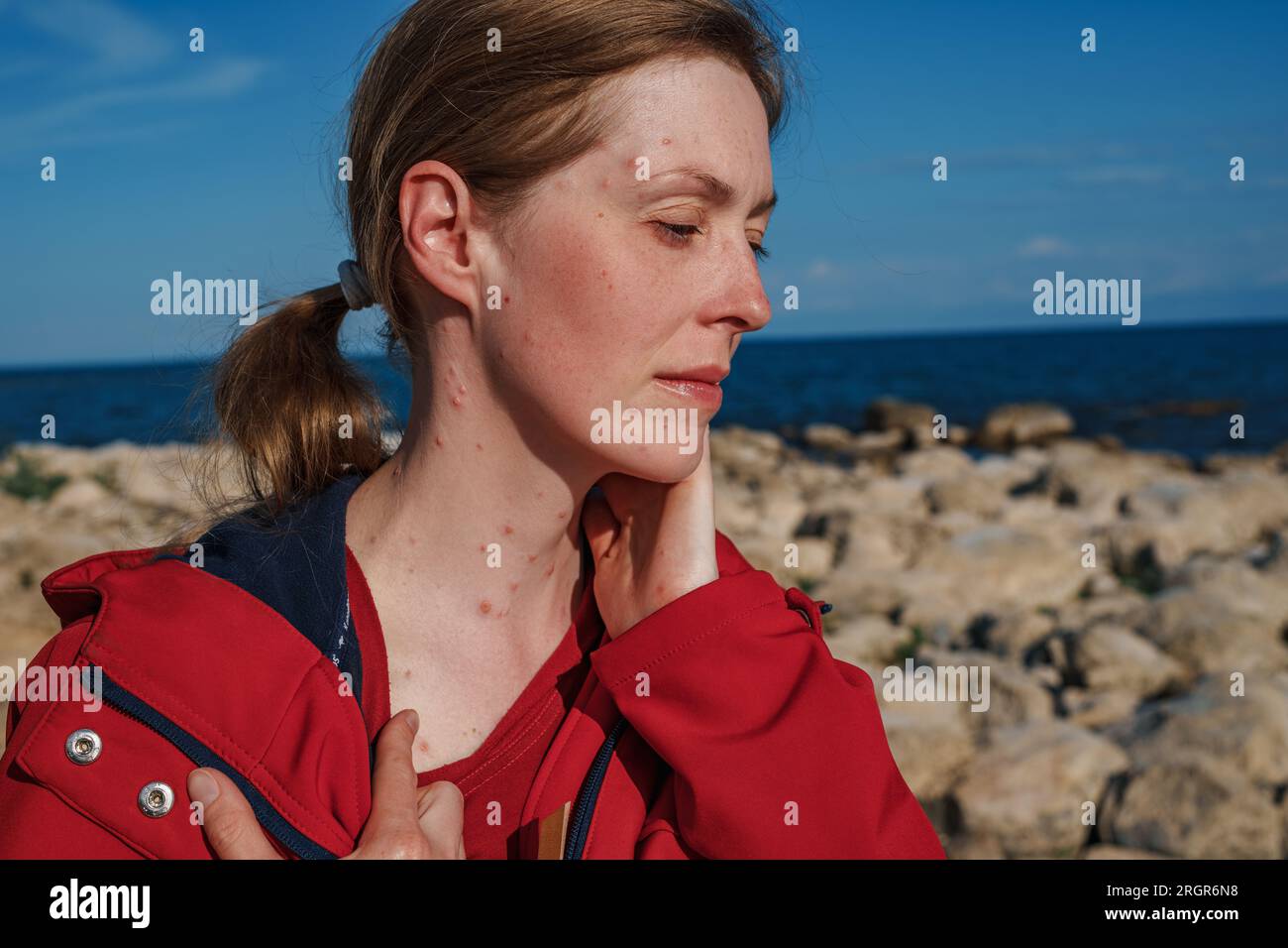 Porträt einer traurigen Frau mit Windpocken am Meer Stockfoto