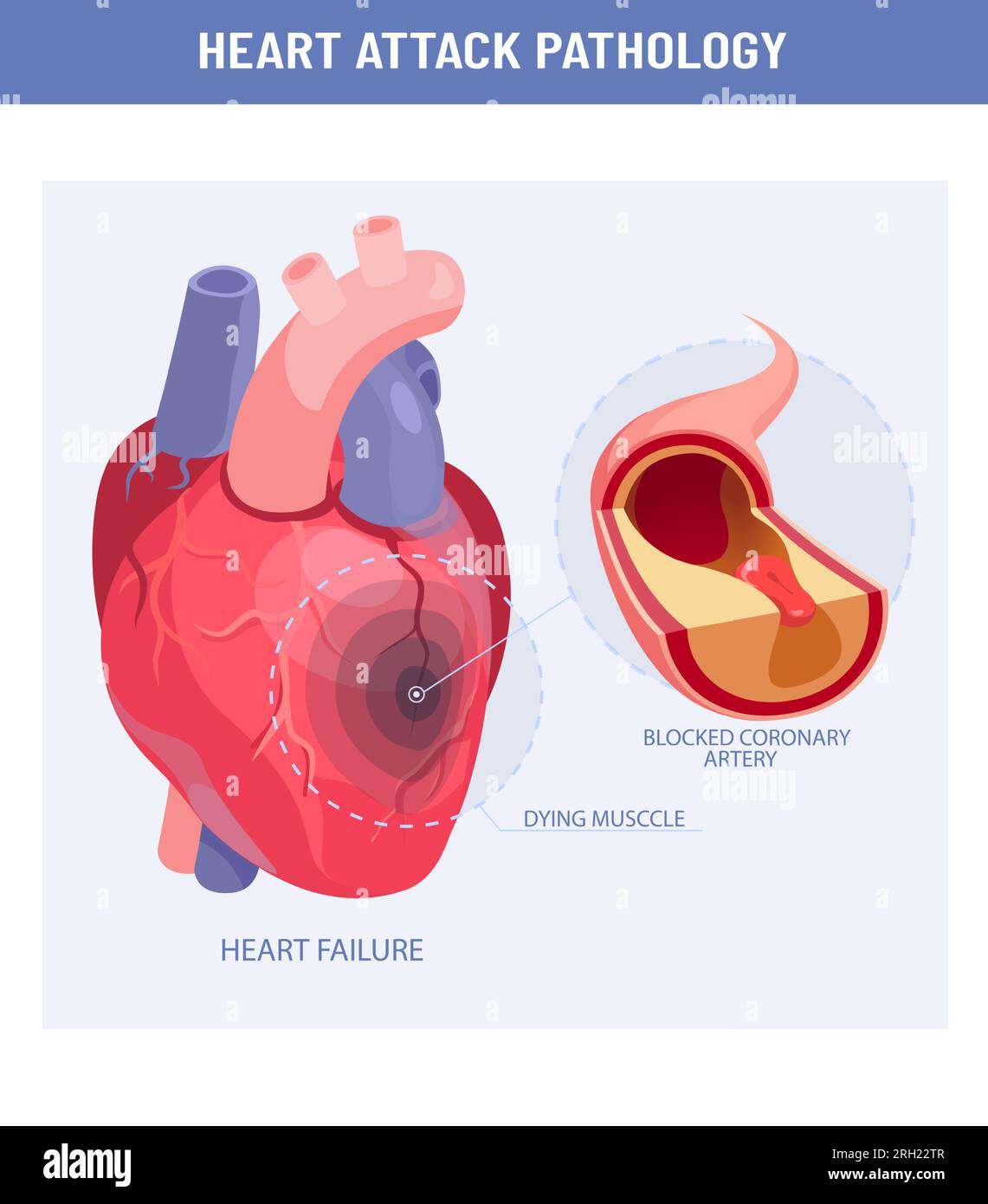 Herzinfarkt und Atherosklerose. Vektor eines geschädigten Herzens, Querschnitt einer Koronararterie mit atherosklerotischer Plaque Stock Vektor