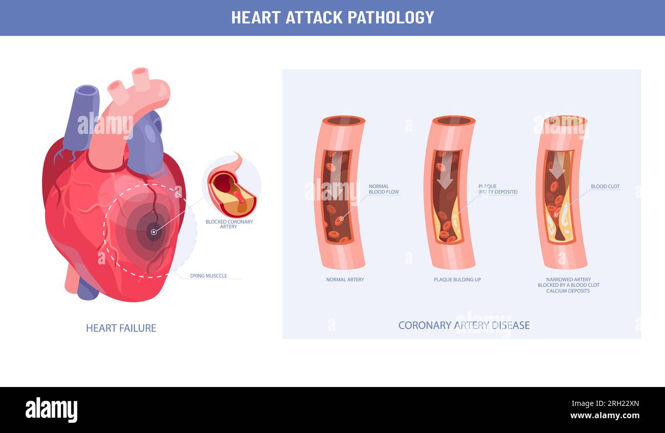 Pathologie eines Herzinfarktes und Atherosklerose-Infografik Stock Vektor