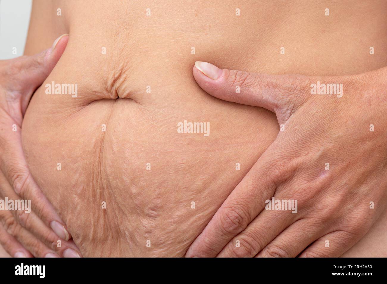 Gekürzte Frau Hände auf dem Bauch gepresste Haut, um schlaffe Haut nach der Diät und Dehnungsstreifen nach der Schwangerschaft zu zeigen Stockfoto