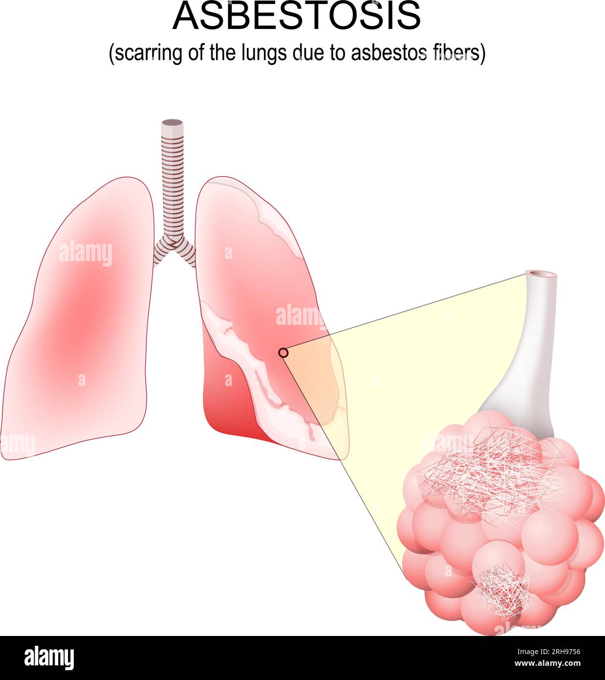 Asbestose. Vernarbende Lungen. Menschliche Lungen mit asbestbedingter Plaque. Alveolusnaht mit Asbestfasern. Vektordarstellung Stock Vektor