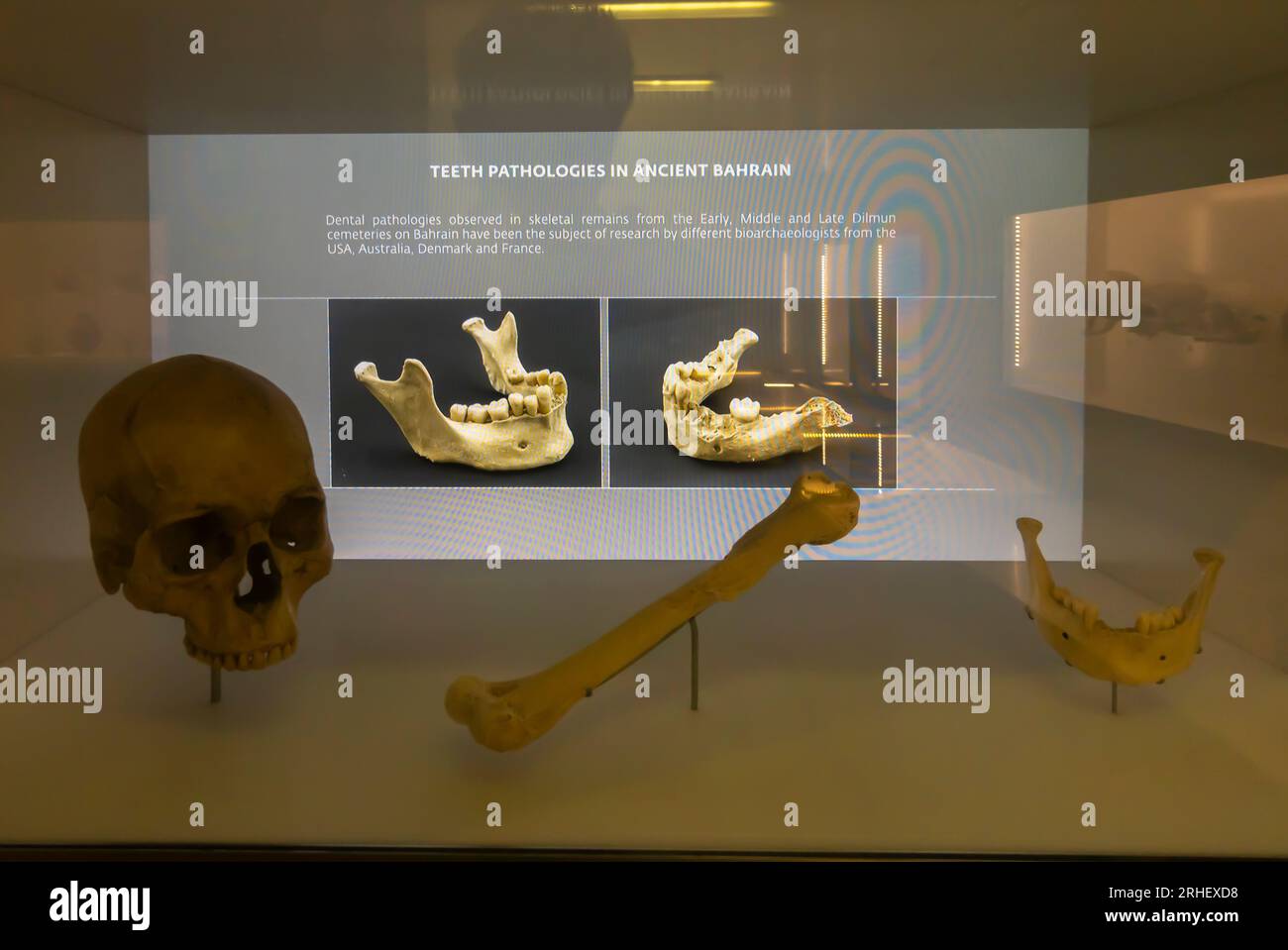 Zahnpatologien im alten Bahrain - Skelettreste aus Dilmun Stockfoto