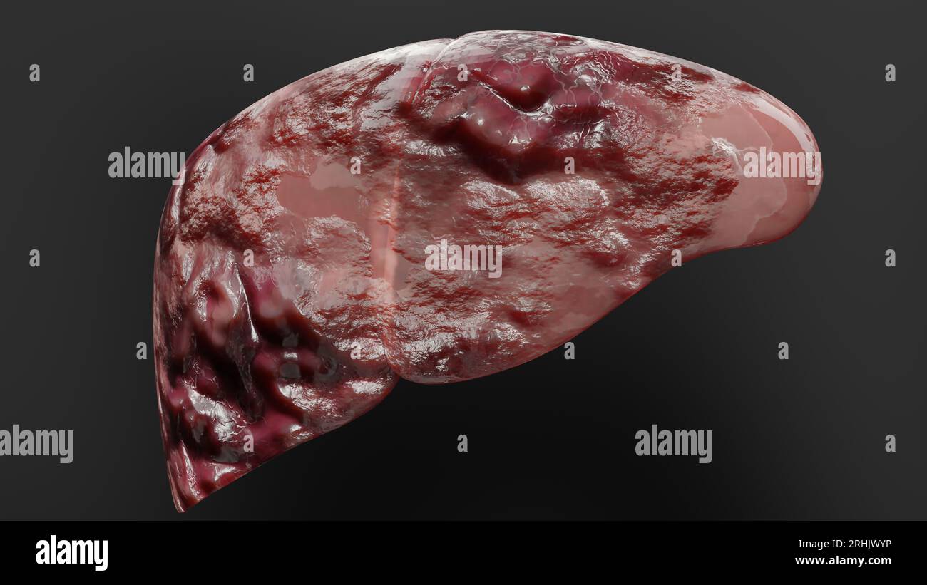Leberkrebs des Verdauungsorgans, Hepatitis Zirrhose maligner Tumor, Leberversagen, wachsende Zellen, Duplikation, Fibrose, Leberzirrhose, hepatozelluläre Ca Stockfoto