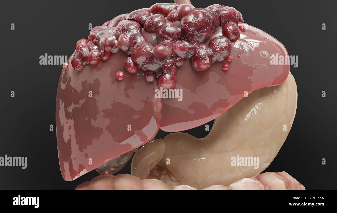 Leberkrebs des Verdauungsorgans, Hepatitis Zirrhose maligner Tumor, Leberversagen, wachsende Zellen, Duplikation, Fibrose, Leberzirrhose, hepatozelluläre Ca Stockfoto