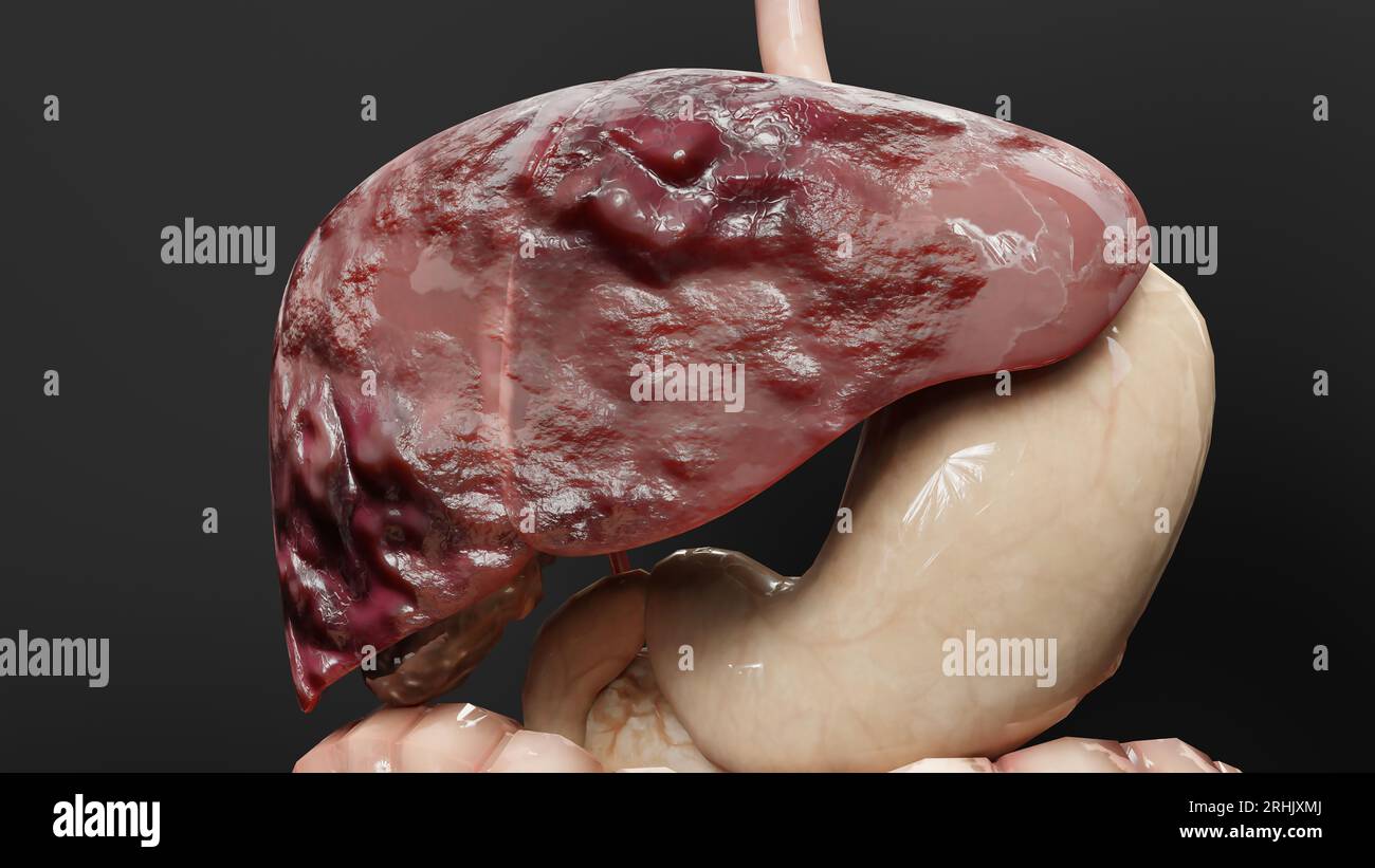 Leberkrebs des Verdauungsorgans, Hepatitis Zirrhose maligner Tumor, Leberversagen, wachsende Zellen, Duplikation, Fibrose, Leberzirrhose, hepatozelluläre Ca Stockfoto