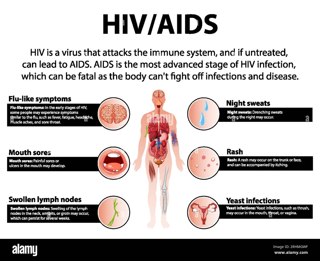 Unterschiede Zwischen Aids Und Hiv Abbildung der Auswirkungen von HIV/AIDS auf Immunsystem, Gehirn, Mund